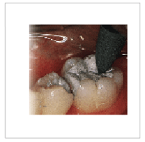 Picture for category Amalgam Reducer